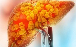 5 “thủ phạm” khiến gan ngập trong mỡ: Ít ai ngờ tới
