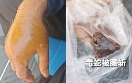 Bị rắn hổ mang chúa dài 2 mét cắn, người đàn ông chém đứt xác rắn rồi đến bệnh viện
