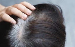 Người trẻ tóc bạc sớm: Bác sĩ chỉ ra 3 dưỡng chất hay bị thiếu hụt, ít người để ý đến