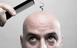 Quốc gia nào có nhiều người hói nhất thế giới?