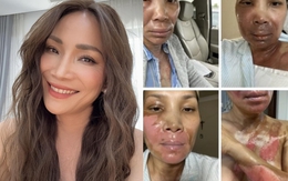 Xót xa nữ nghệ sĩ đình đám bị bỏng nghiêm trọng vì nổ nồi xông hơi: "Còn sống là hạnh phúc"