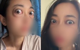 Nhìn đôi mắt "ếch" của người phụ nữ, ai cũng thương, câu chuyện phía sau là bài học cảnh tỉnh nhiều người trẻ