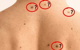 Nổi nhiều nốt ruồi là dấu hiệu ung thư?