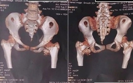 Bé gái 12 tuổi mắc "hội chứng người hóa đá hiếm gặp", bố mẹ ngỡ ngàng khi bác sĩ nhắc tới cú ngã xe đạp 2 năm trước