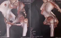 Phát hiện hội chứng "người hóa đá" thể hiếm ở một bé gái 12 tuổi
