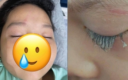 Chỉ 1 phút lơ là mà con gái suýt mù mắt, mẹ bỉm chia sẻ bài học “xương máu” và cách sơ cứu giải nguy trong gang tấc