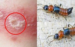 5 bước xử lý đúng cách khi tiếp xúc với kiến 3 khoang