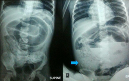 Bé trai đau bụng dữ dội, nôn ói suốt 3 ngày: Bác sĩ mổ khẩn, phát hiện thứ khó tin chặn kín ruột