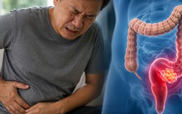 Bác sĩ cảnh báo: 4 DẤU HIỆU sớm của ung thư trực tràng, nhiều người nhầm với đau, chướng bụng bình thường
