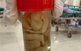 Phát hiện sán dây 1,2m trong ruột người đàn ông: Bác sĩ chỉ ra thói quen ăn uống vạn người mê là nguyên nhân
