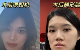 Nữ người mẫu 24 tuổi phẫu thuật thẩm mỹ từ bị móm nhẹ thành mặt lưỡi cày: Lời giải thích của bác sĩ gây phẫn nộ