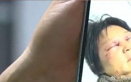 Con dâu đánh gãy xương sườn mẹ chồng vì không chịu trông cháu, con trai bênh vợ khẳng định “mẹ có lỗi trước"