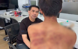 Nam thanh niên đi làm với mình mẩy thâm tím, sếp hỏi chuyện mới phát hiện nhân viên bị mẹ kế bạo hành