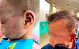 Khởi tố cha dượng đánh bé 3 tuổi bầm tím mặt mũi