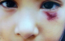 Phụ huynh tố cô giáo đánh bầm mắt bé mầm non