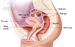 Nhìn tận mắt các giai đoạn của ung thư nội mạc tử cung