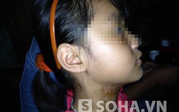 Hình ảnh đau lòng về bé gái bị dì ghẻ đánh, bóp cổ ở Hải Dương