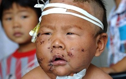 Trung Quốc: Bé 8 tháng tuổi bị mẹ đâm 90 nhát kéo