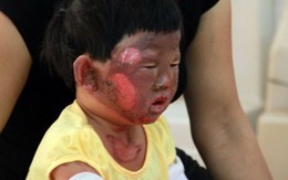 Đổ xăng, 5 người trong một gia đình bỏng nặng