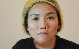 Xuất hiện ảnh gương mặt sứt sẹo vì tai nạn của ca sỹ Anh Thúy