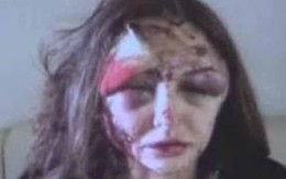 Siêu mẫu bị người yêu đại gia hành hạ khủng khiếp