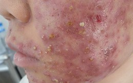 Kinh hãi chuyện làm đẹp: Kem trộn và... ký sinh trùng