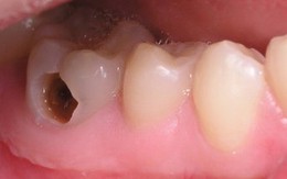 9 bệnh về răng mọi người hay mắc
