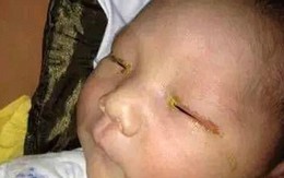 Xót xa em bé 3 tháng tuổi bị mù vì đèn flash của máy ảnh