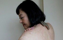 "Em bé Napalm" Phan thị Kim Phúc sẽ xóa bỏ toàn bộ những vết sẹo 43 năm tuổi