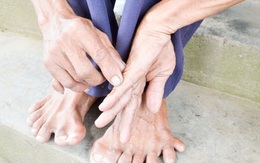 Gia đình có chân tay kỳ lạ nhất ở Việt Nam
