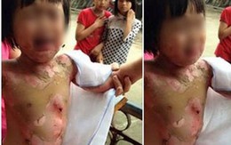 Mẹ bé mầm non bị đốt: Đau nhưng không biết, không muốn trách ai