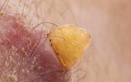 Video: Kinh hãi xem ấu trùng ruồi chui ra từ da người