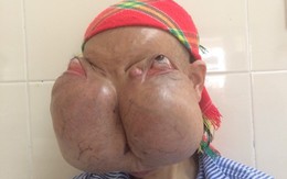 Người phụ nữ "đeo" 2 khối u khổng lồ trên mặt