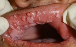 Bệnh sùi mào gà có lây qua đường ... máy giặt?