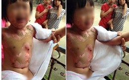 Cô giáo bàng hoàng kể giây phút bé 3 tuổi bị bạn đốt ở Yên Bái