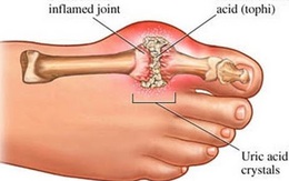 Biến chứng kinh khủng của bệnh gút nhiều người mắc do chủ quan