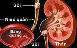 Trị sỏi thận bằng bài thuốc cực đơn giản chỉ 7 ngày ra hết sỏi