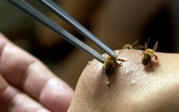 Thiếu nữ suýt tử vong vì bị hơn 100 con ong vò vẽ chích