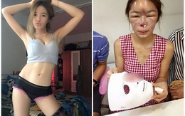 Phẫu thuật hỏng, hot girl xinh đẹp mang gương mặt nát bét