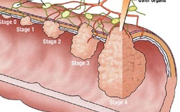 Giật mình vì trực tràng cháu bé 10 tuổi chen chúc 30 polyp