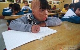 Hành trình 4 năm sống sót kì diệu của cậu bé bị cha ruột đổ xăng đốt biến dạng