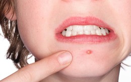 Vị trí mọc mụn nói gì về sức khỏe của bạn?