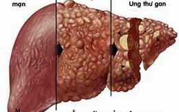 Kinh hoàng căn bệnh khiến 2 tỷ người mắc