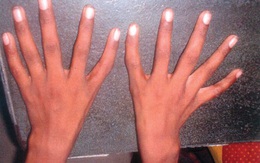 Bí hiểm hội chứng "bàn tay ngoài hành tinh" biến ngón cái thành... ngón trỏ
