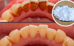 Không đi nha sĩ và sử dụng thuốc hóa chất, cao răng vẫn sạch bóng nhờ 2 cách đơn giản sau