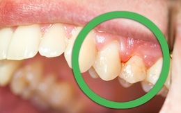 Cách dùng bàn chải sai lầm khiến bạn rụng răng có ngày