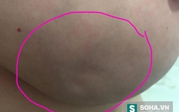 Bức ảnh 3 vết lõm trên ngực có thể cứu sống hàng triệu phụ nữ