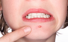 Bị mụn ở 15 vị trí sau sẽ vô cùng nguy hại sức khỏe!