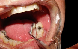 Những bài thuốc tại nhà "trị" chứng đau tủy răng