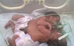 Hai bé song sinh dính liền được bác sĩ xin từ thiện đã tử vong